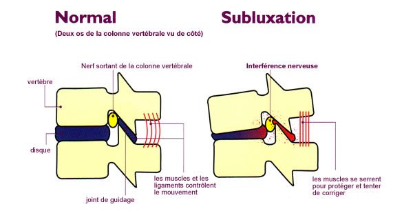 subluxation